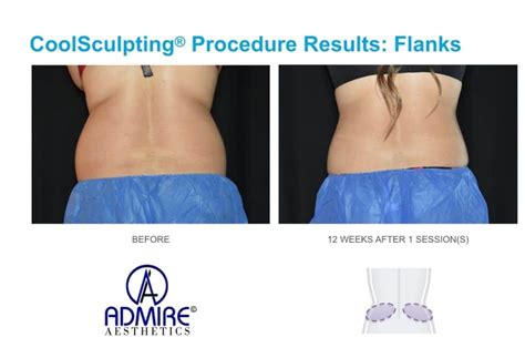 how to speed up coolsculpting results|How to Speed Up Your CoolSculpting Results: A Quick Guide.